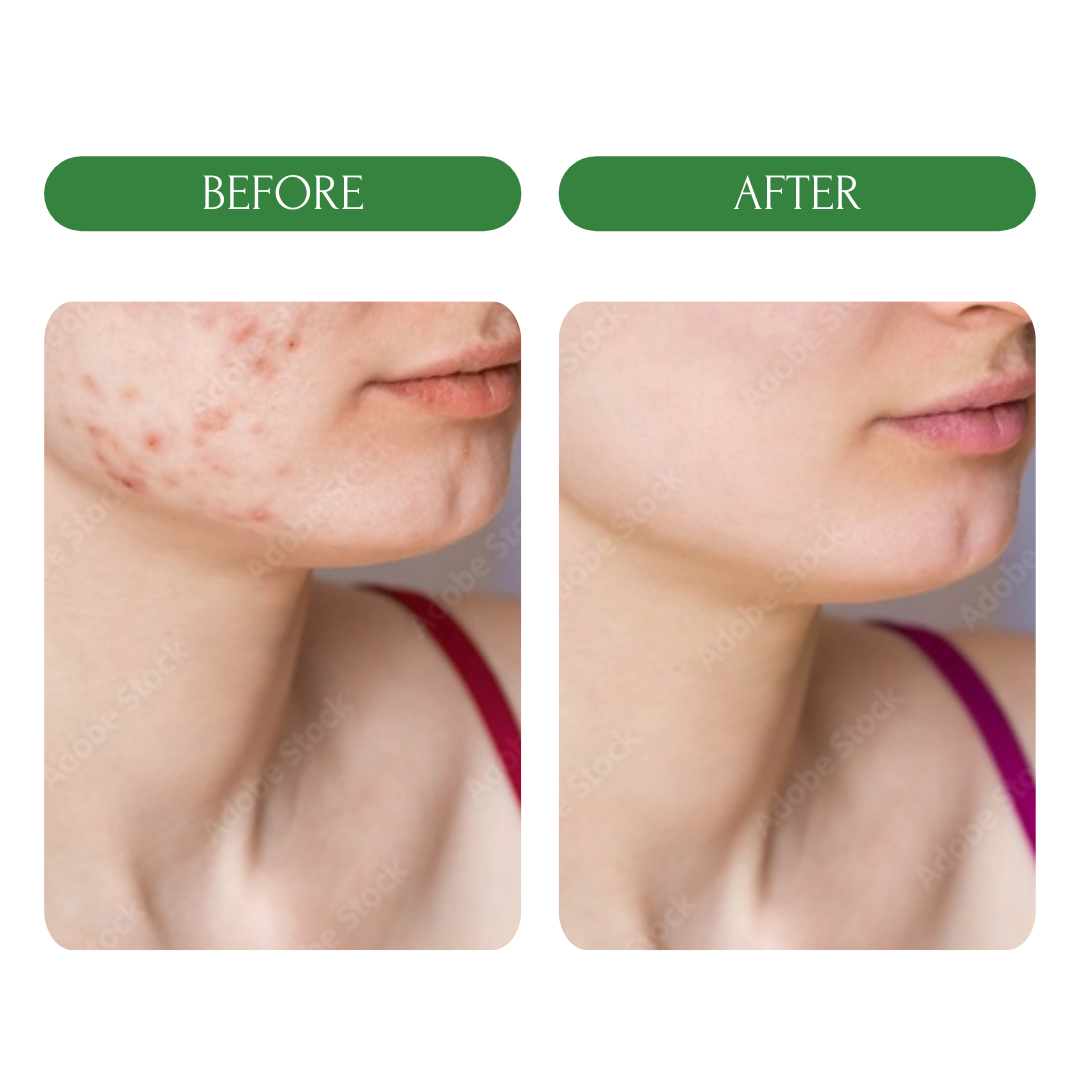 TEA ORGANIC ACNE SOAP